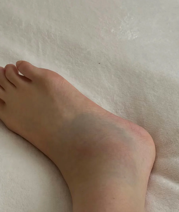 脚扭伤筋在医学上叫踝关节筋骨扭伤,通常需要一个月左右才能恢复