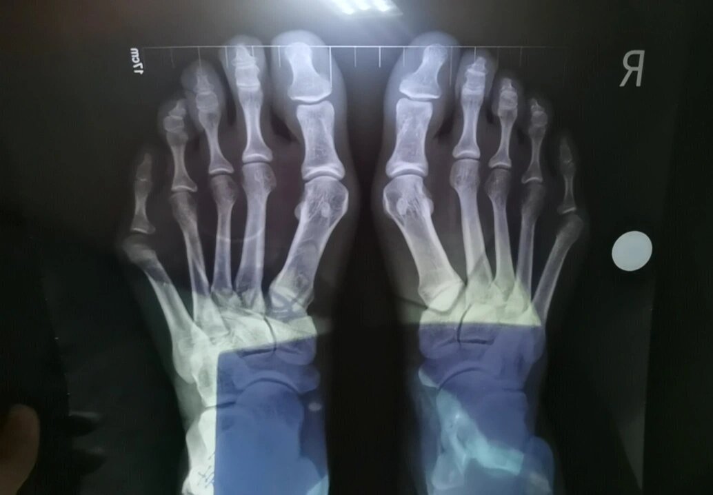 突然发现,我的拇外翻,小趾内翻,足横弓塌陷似乎不是脚趾的问题,而是第