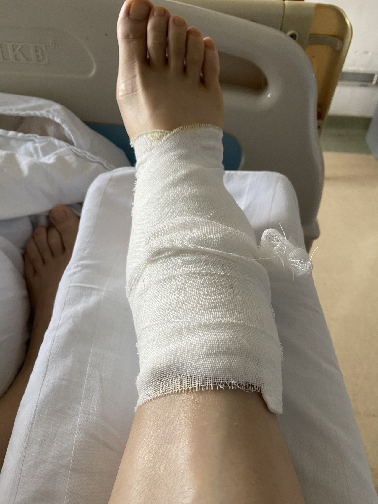 小腿骨折,历时13个月,昨天终于拆钢板了