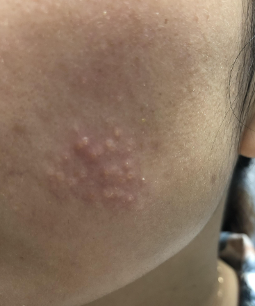 比如环境因素,激素变化,药物反应,过敏反应或者湿疹