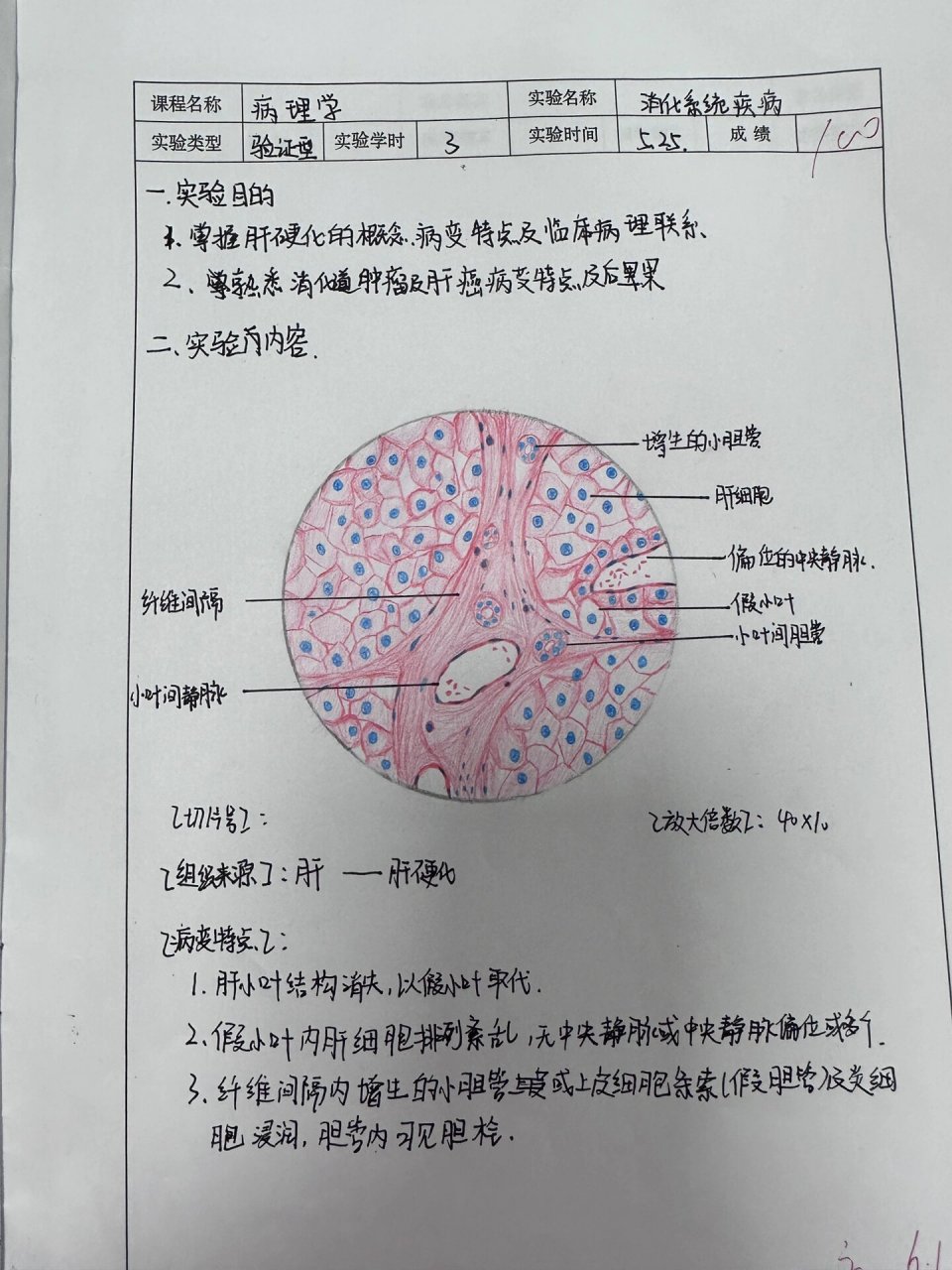 肝硬化手绘图实验报告图片