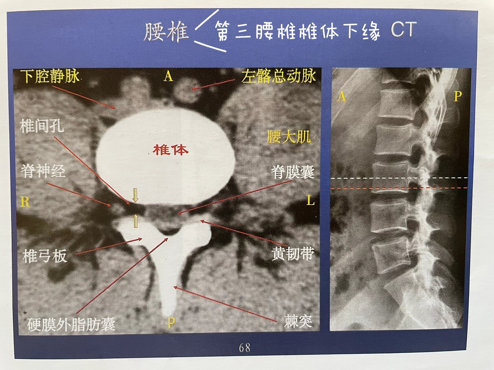 腰椎(椎间盘)横断面ct解剖 平行于椎体终板作腰椎横断ct扫描,正常腰椎