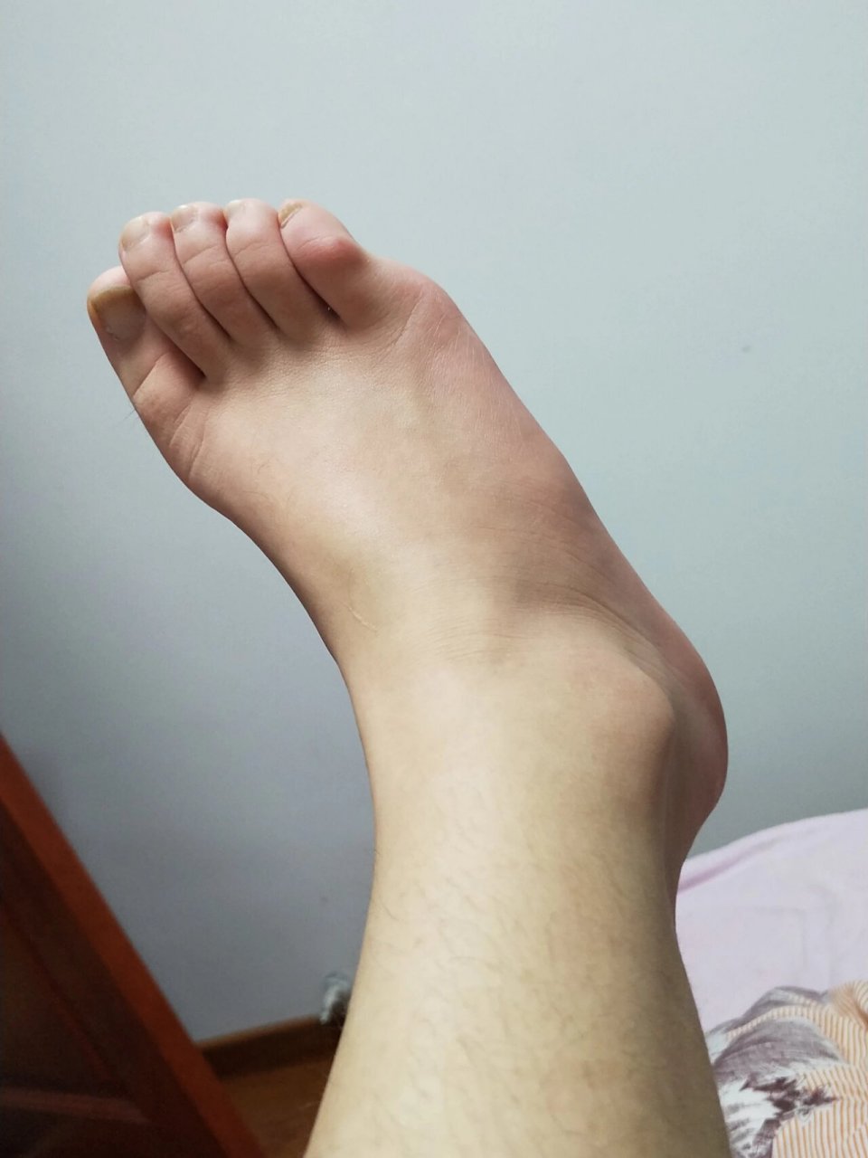 右脚第五跖骨骨折第82天