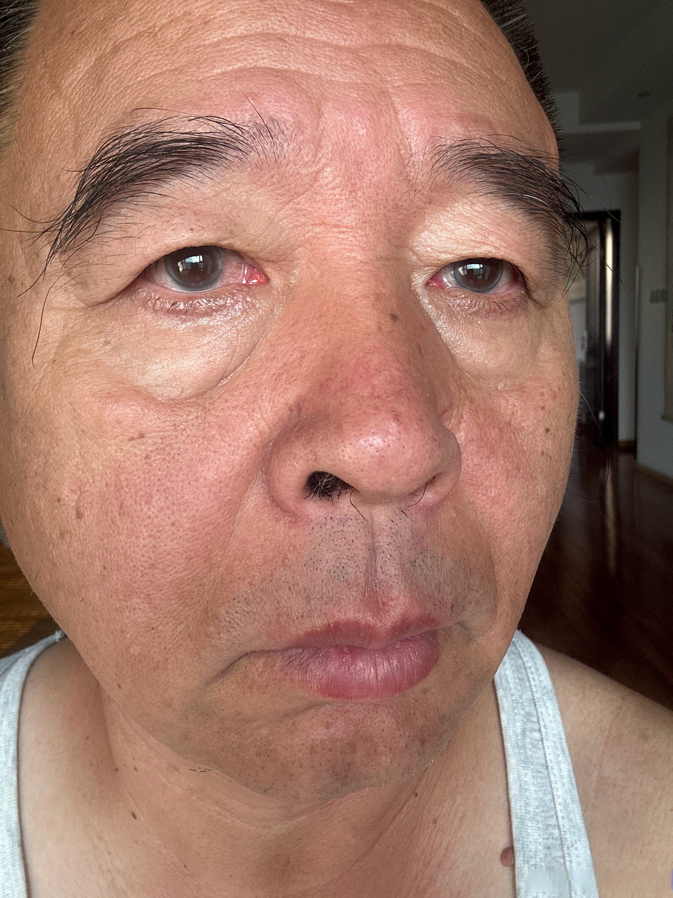 在记录一下右眼的变化,把前边的照片也记录一下,又