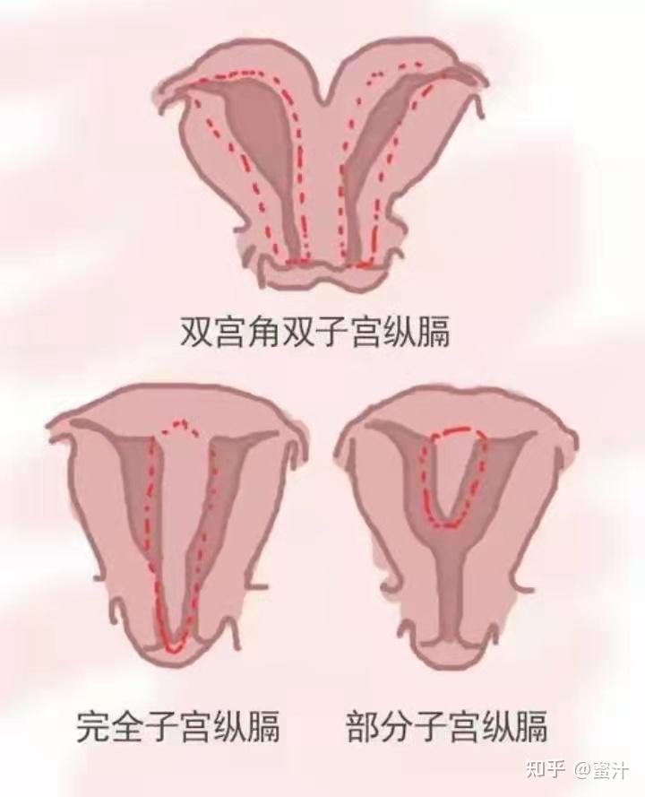 不全纵隔子宫y型图片图片