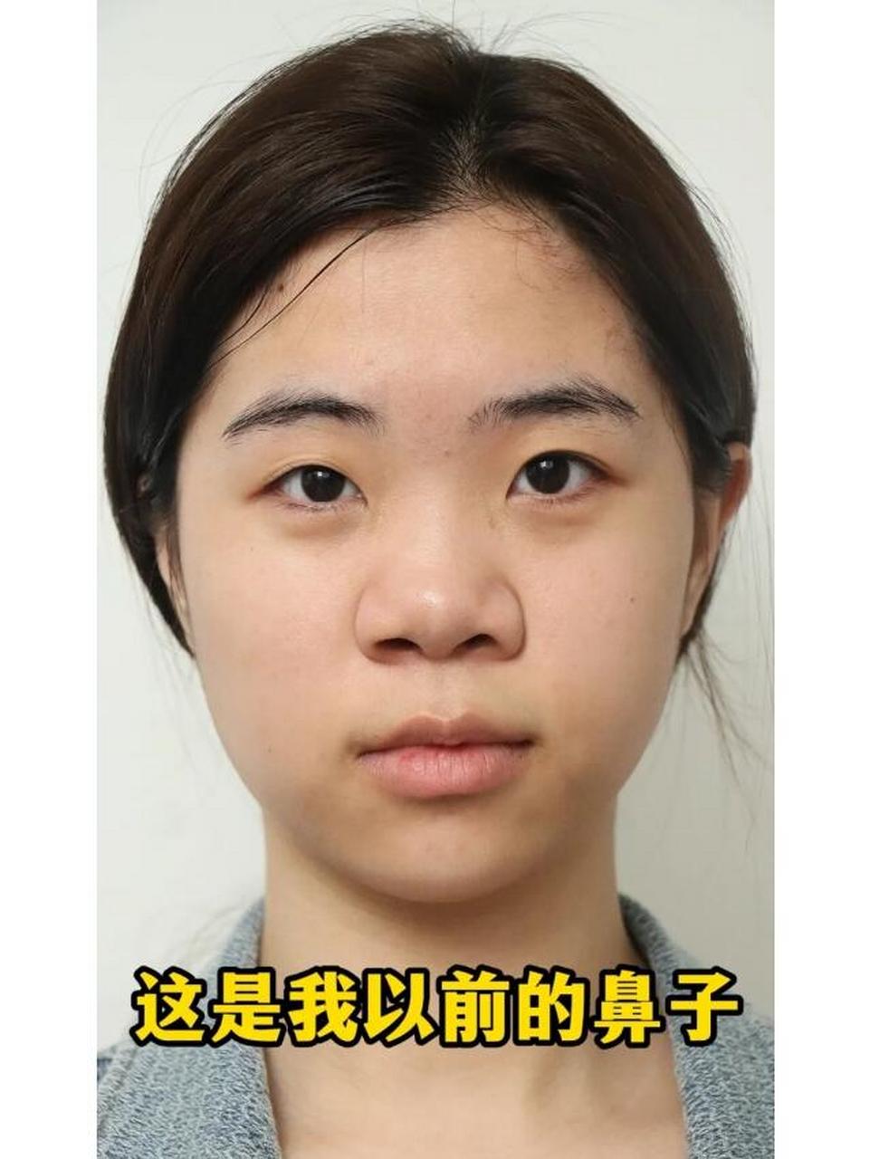 以前的鼻子:鼻小02柱短而偏曲02鼻宽02鼻梁粗大02鼻子扁平不