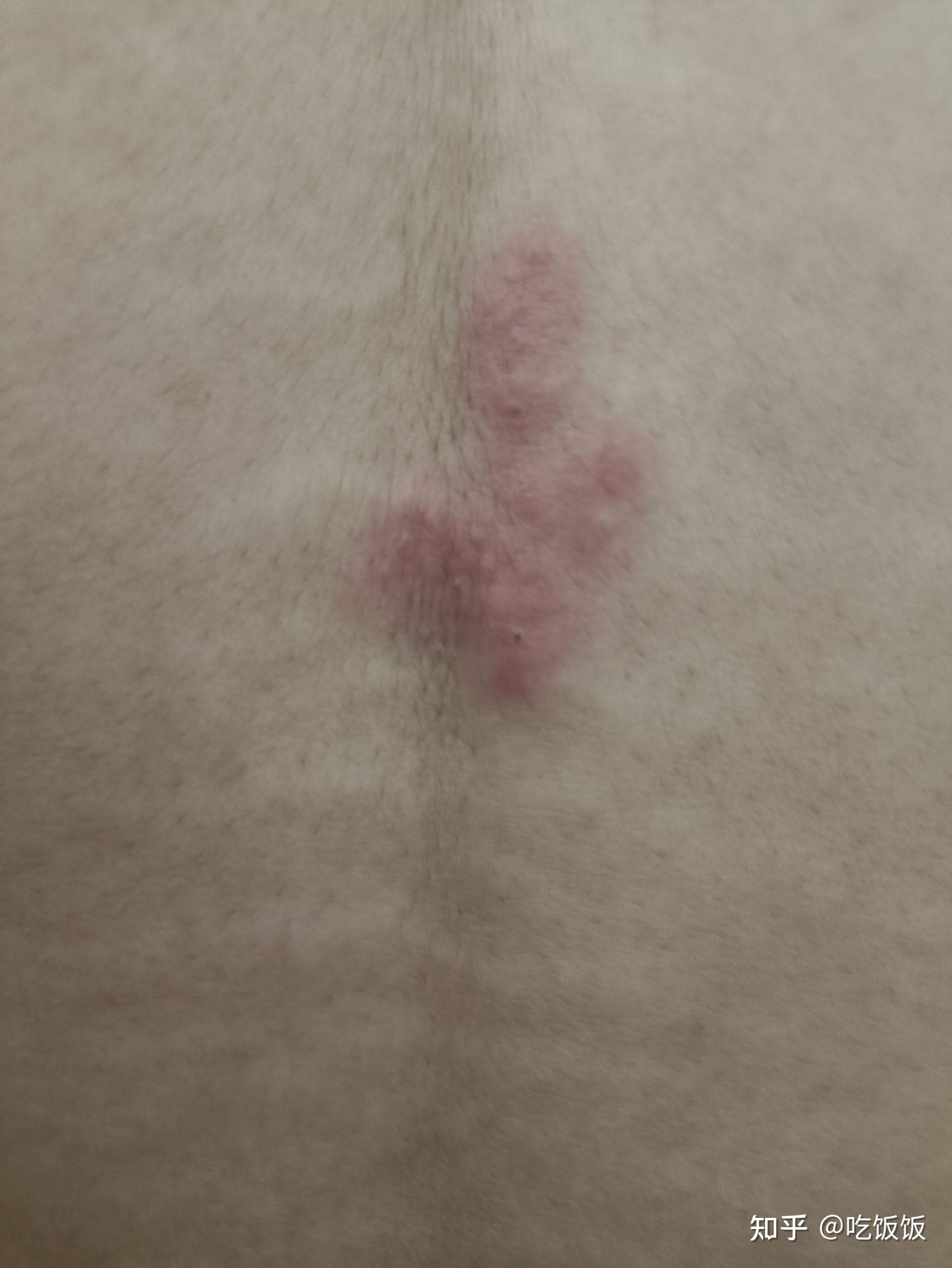 后背长了一块红红的东西有点痒按压有点疼