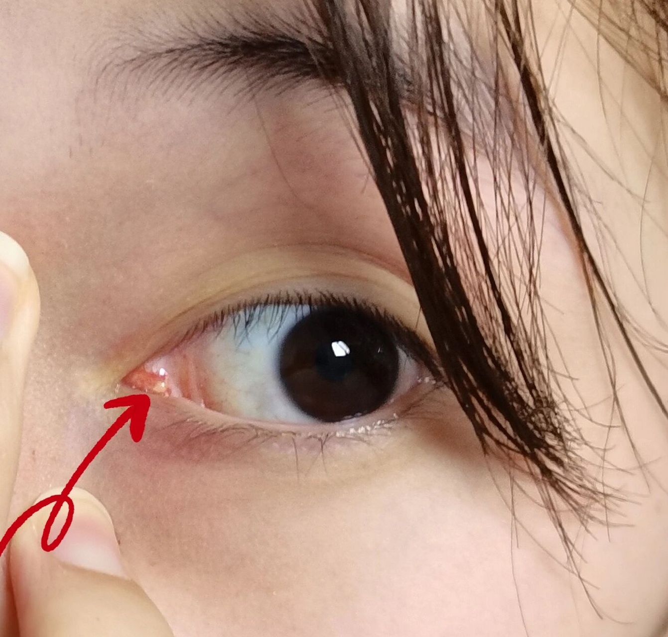 救命啊我洗脸的时候发现左眼眼角里面靠近眼球的地方长了个这个玩意儿