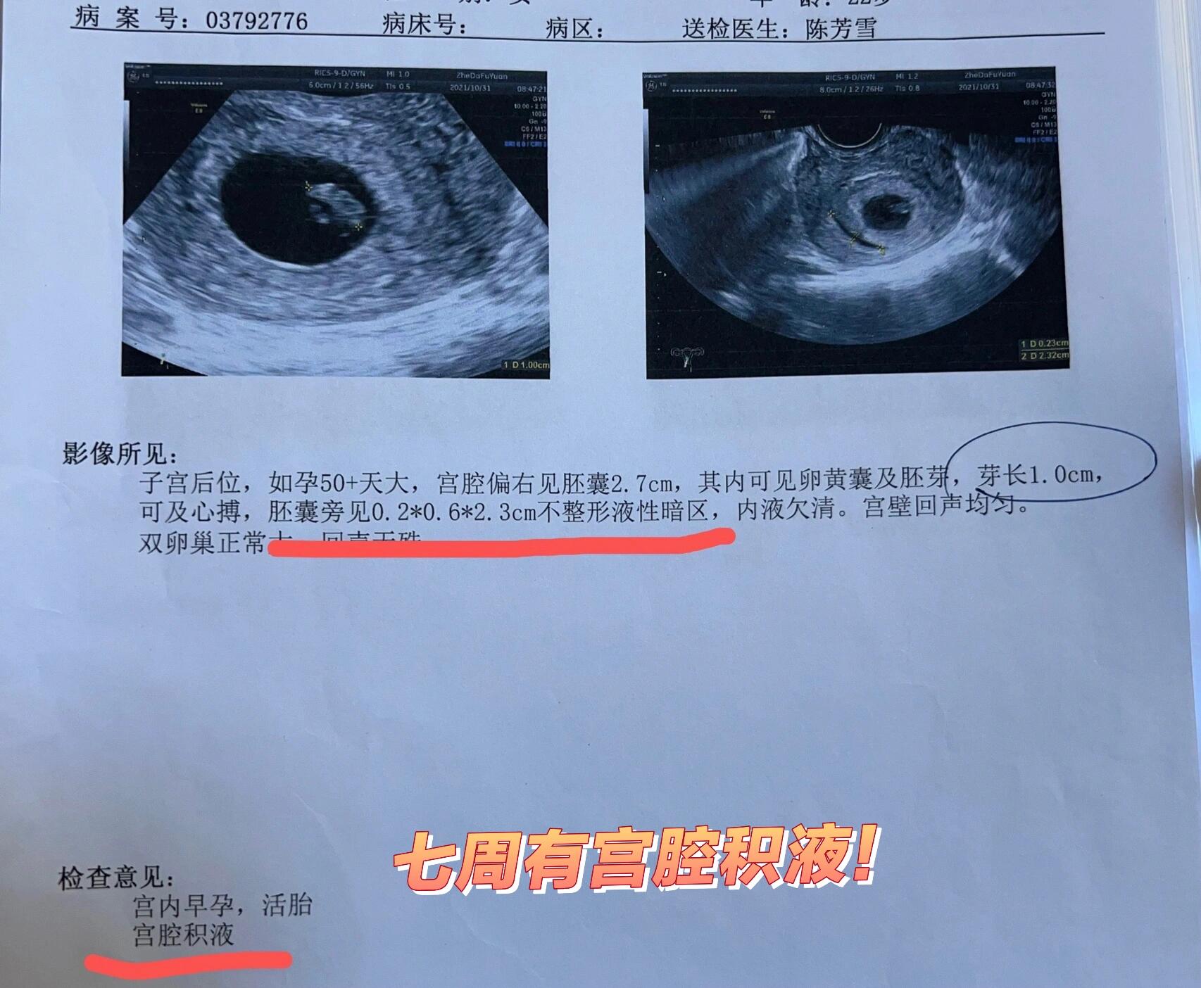 宫腔积液不要怕!真的没事,都会吸收的!