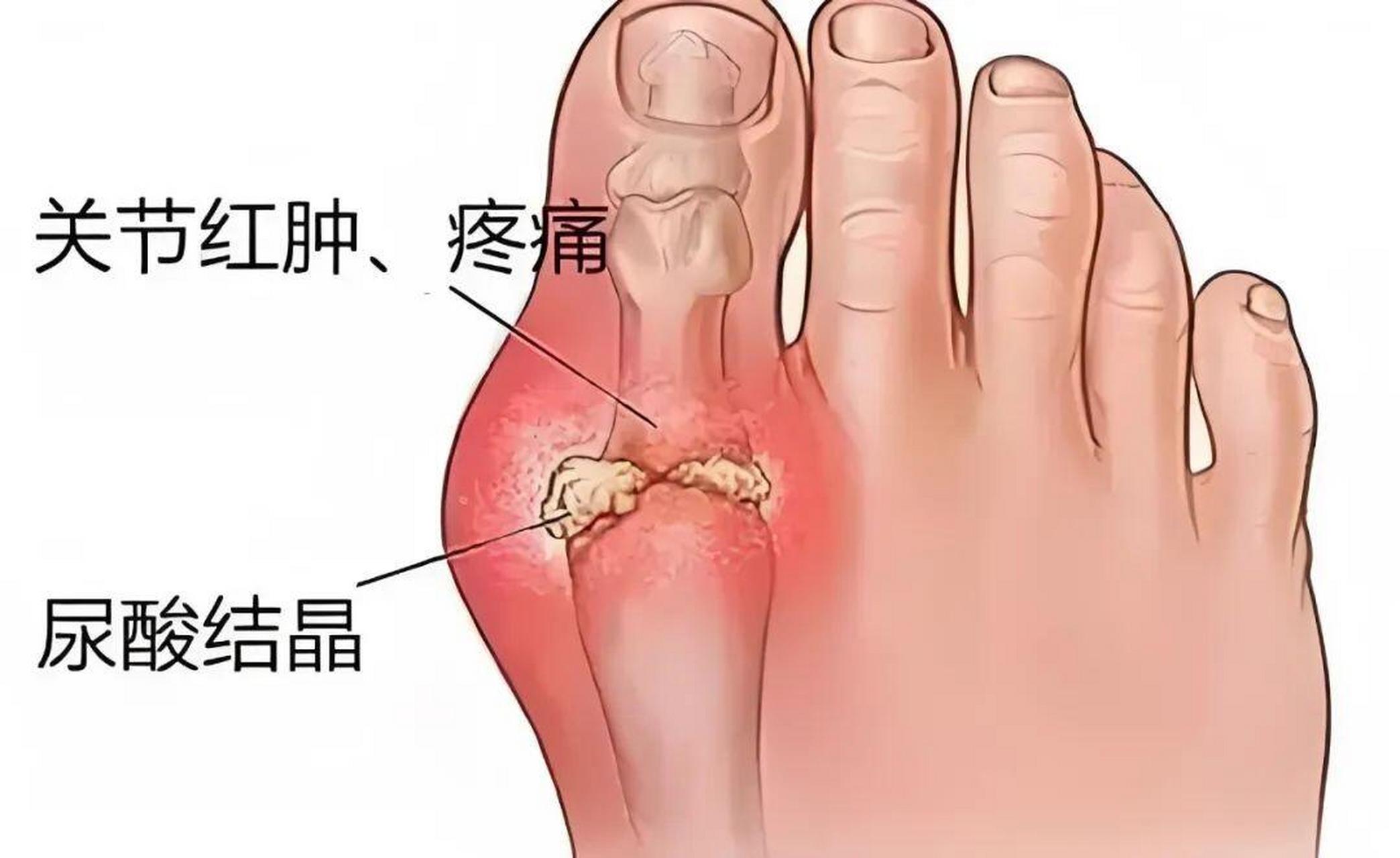 痛风性关节炎,一种因尿酸代谢失衡而导致的关节炎症,对于那些疑似遭受