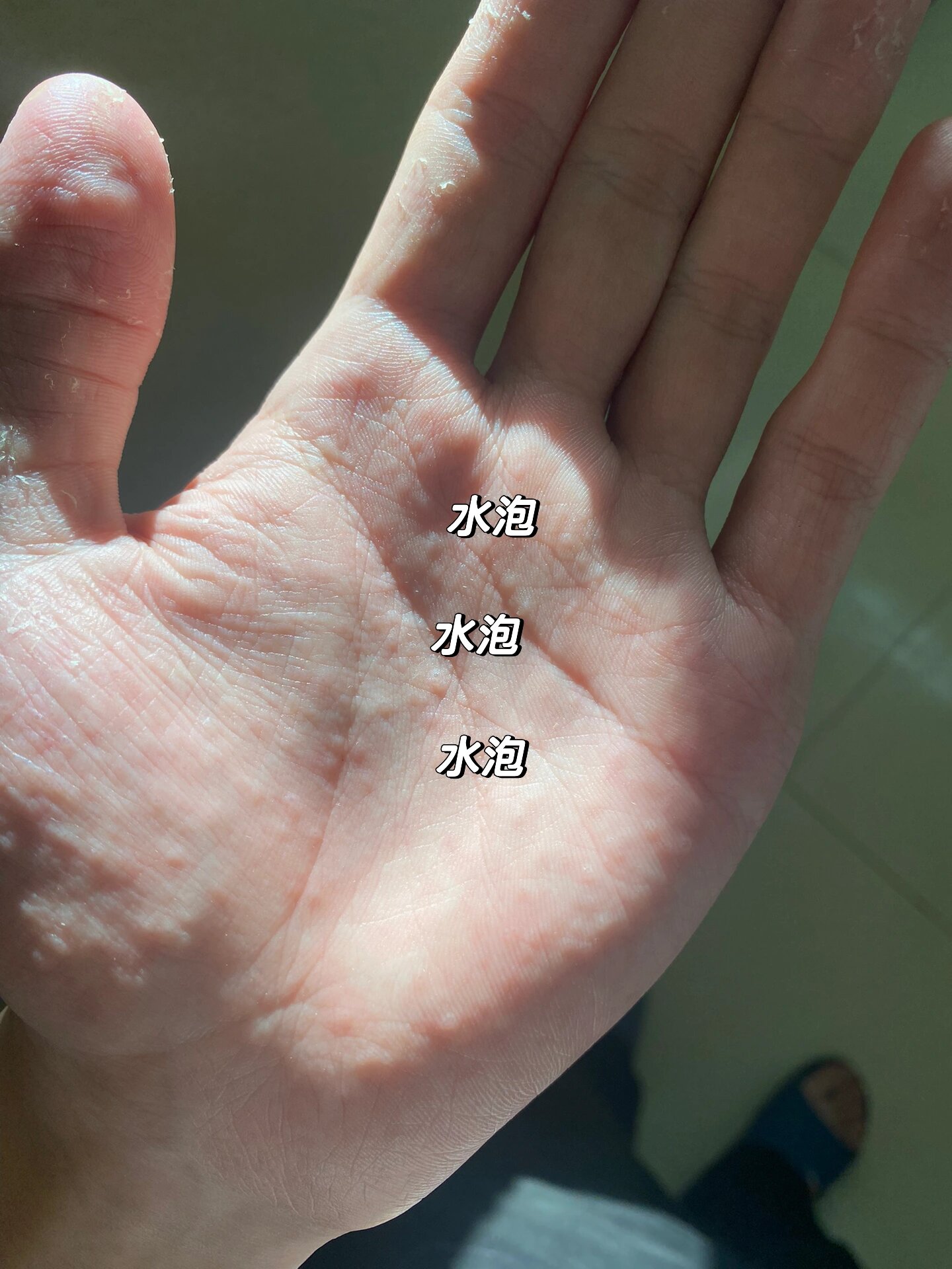 手掌上长水泡是什么原因? 手掌心长水泡