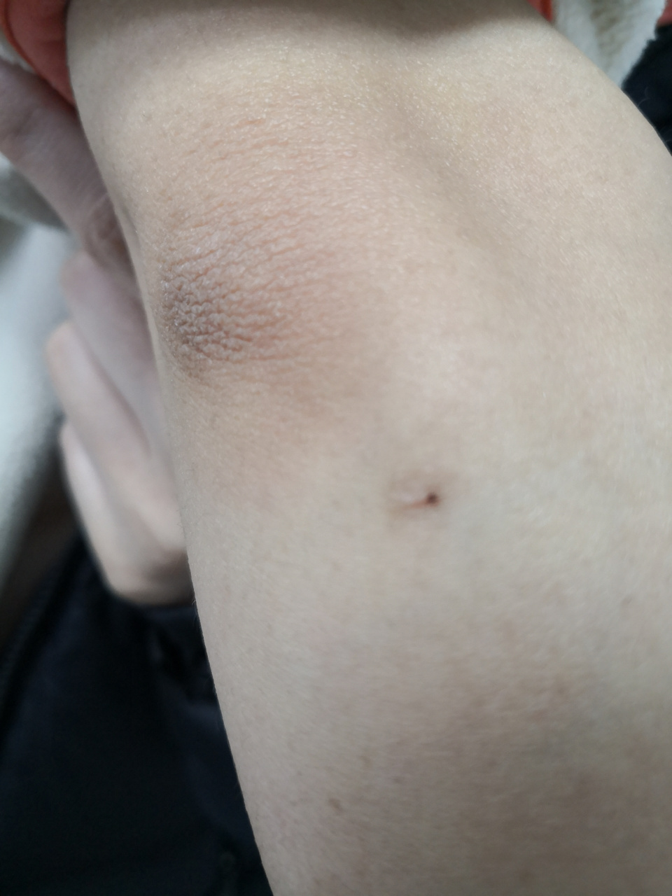 肘关节部位的色素痣症状.#色素痣