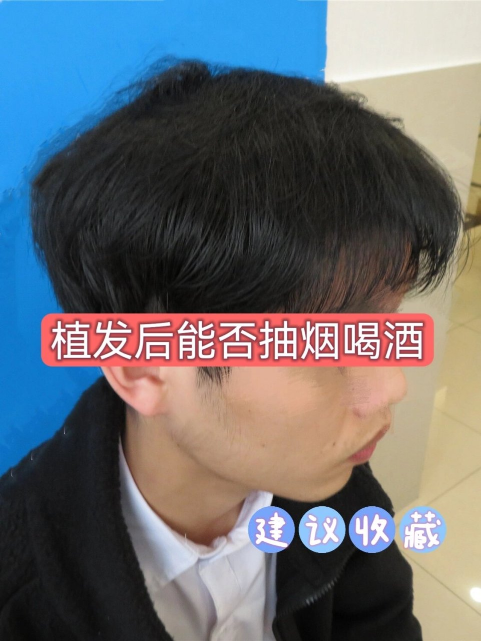 植发多久吸烟(植发多久吸烟有危害)