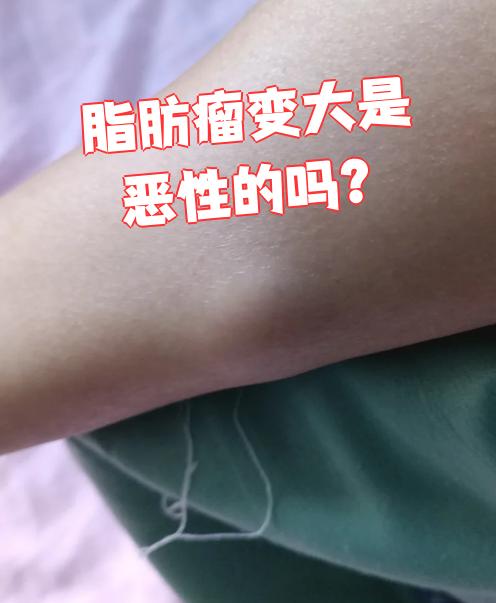 脂肪瘤是皮下脂肪细胞堆积形成的良性肿瘤,癌变概率很低