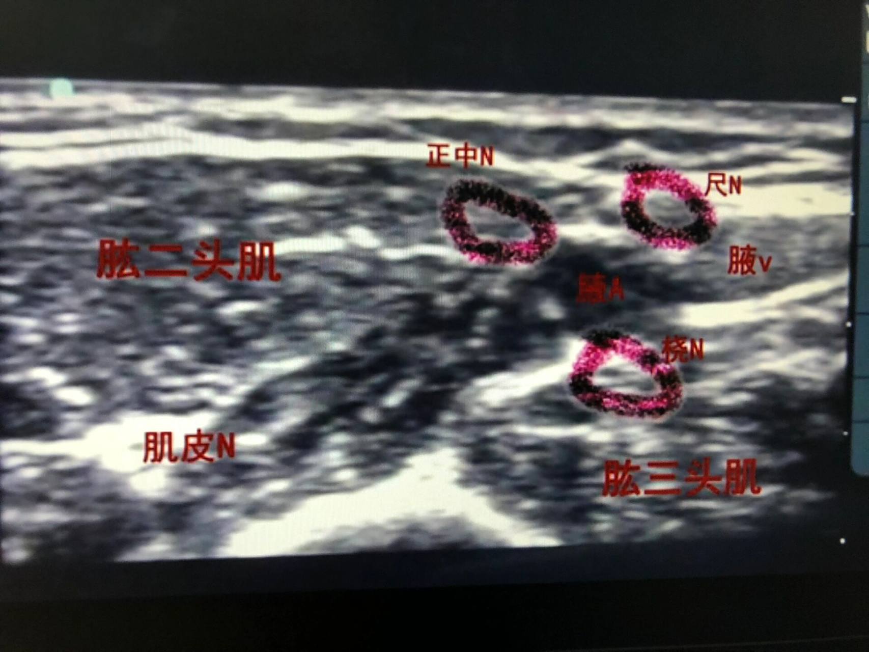 b超下臂丛麻腋路神经分布图 手外伤常做的b超引导下臂丛神经阻滞
