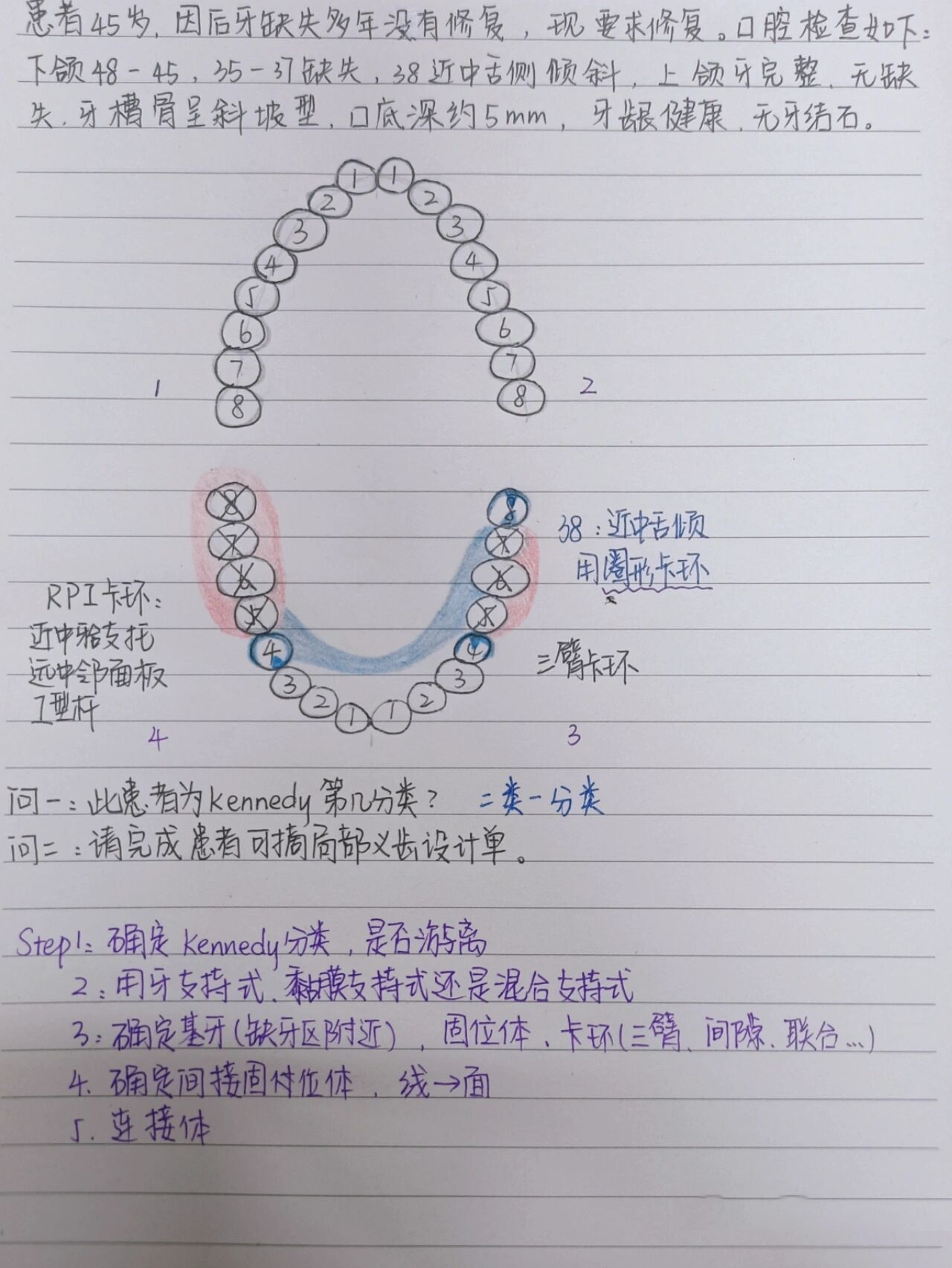 可摘局部义齿设计单 卡环: 圈形卡环:多用于远中孤立的磨牙(上颌牙向
