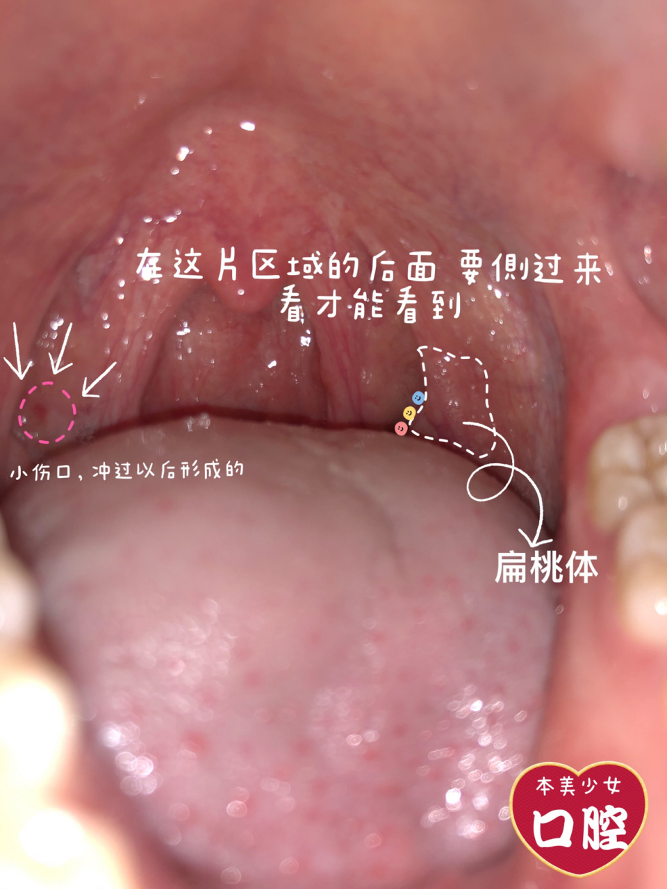 扁桃体结石的位置91 好多宝问我扁桃体在哪 我也不清楚是不是每个人
