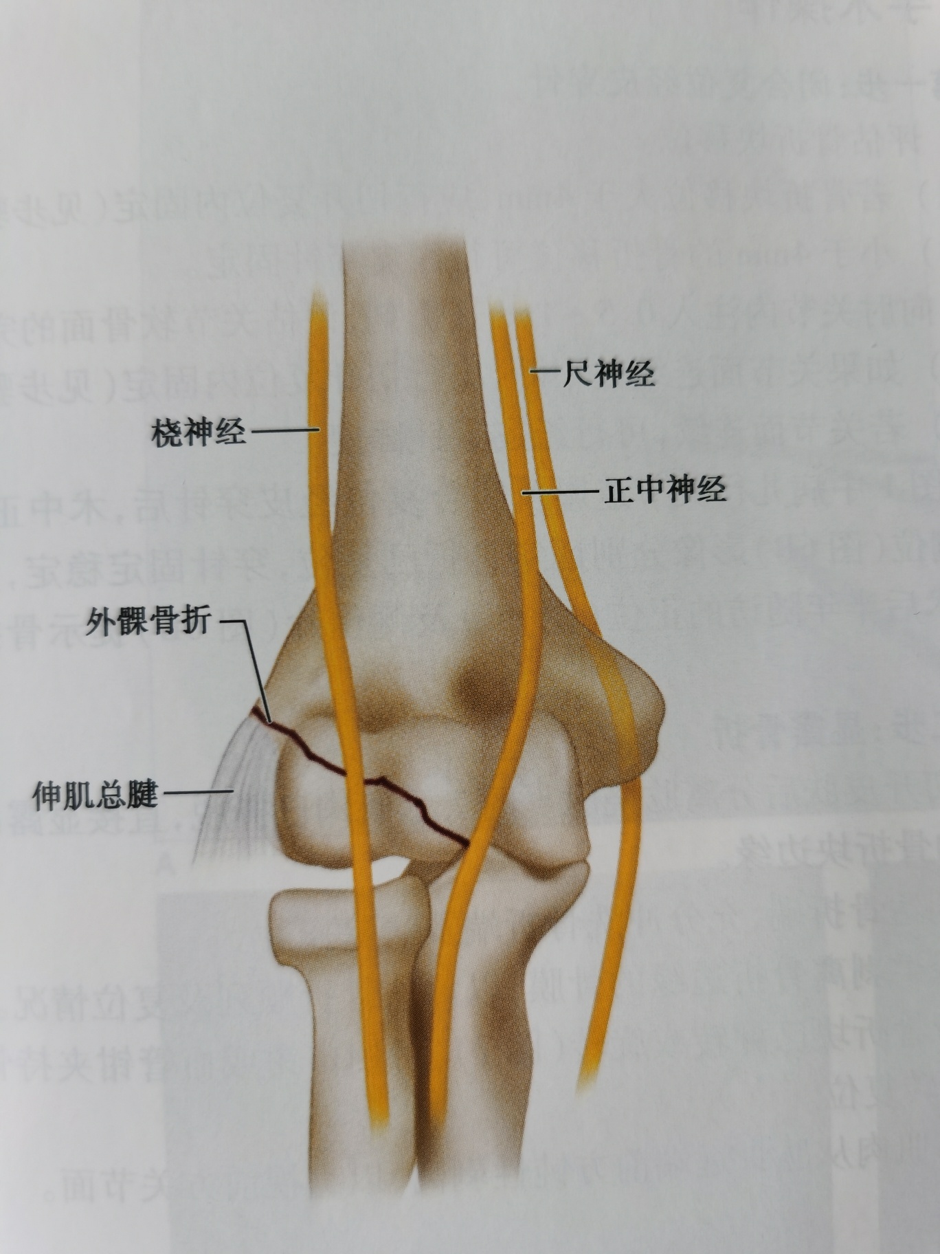 儿童肱骨外髁骨折图片