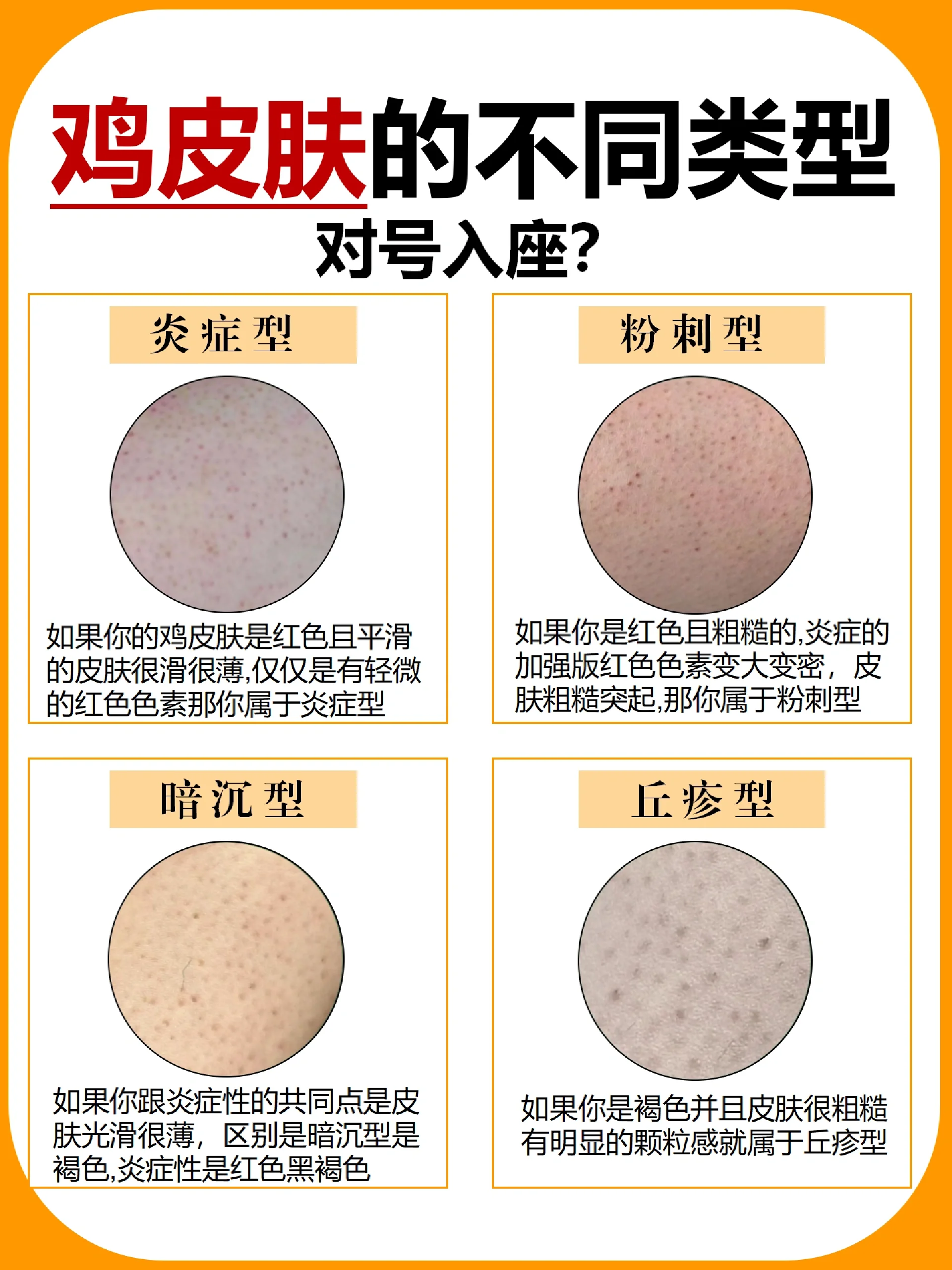 鸡皮肤主要有4种类型: 炎症型,粉刺型,暗沉型,丘疹型 - 该如何淡荒刎