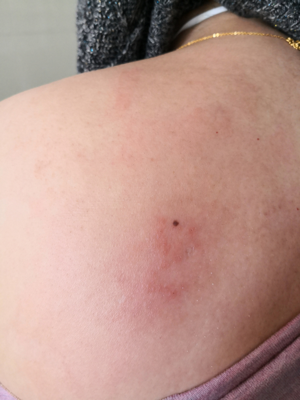 背部带状疱疹早期症状.红斑丘疹#带状疱疹
