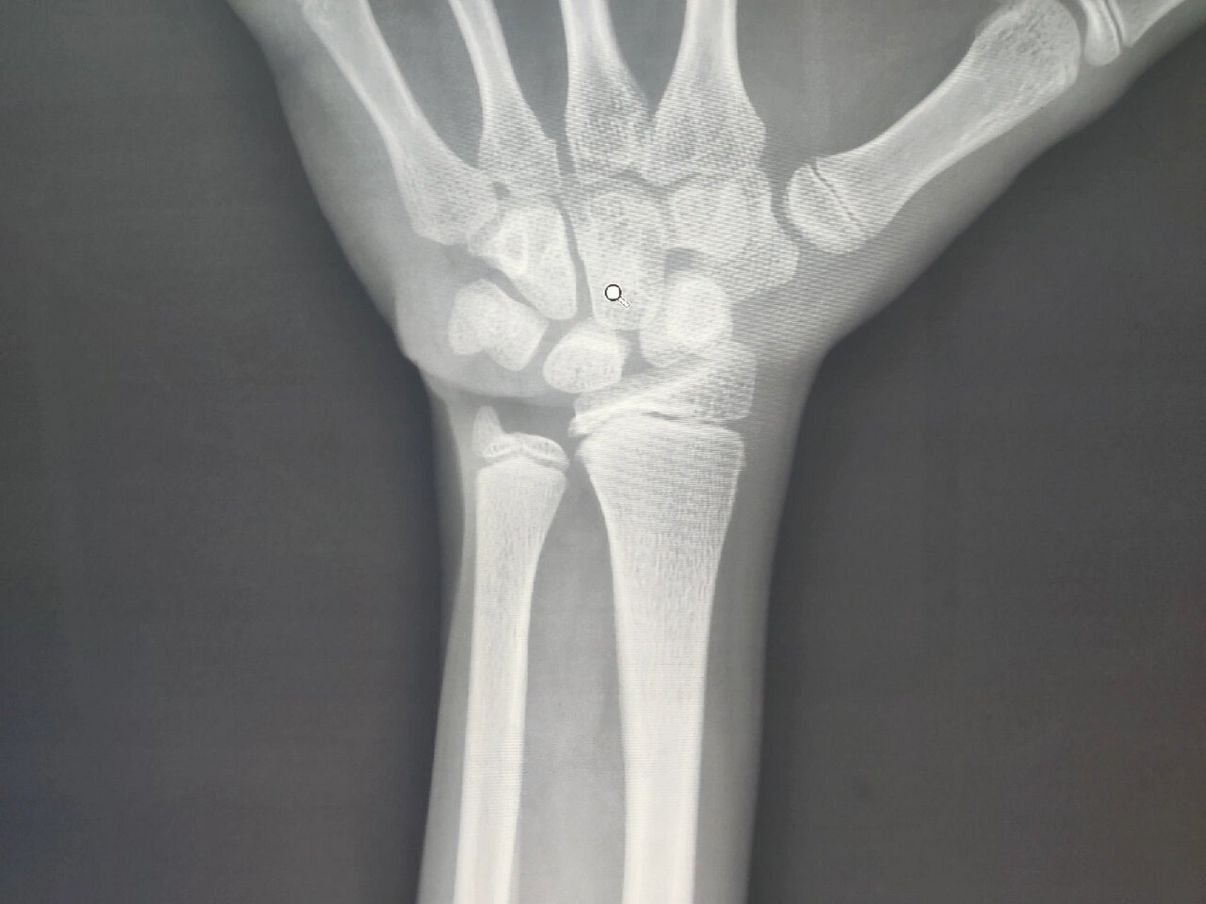 马德隆畸形 桡骨远端向掌侧弧形突出 远端桡尺骨关节关节间隙变宽