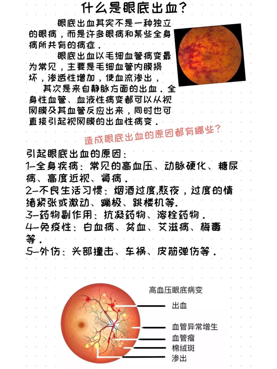 眼底出血 眼底出血,与看到的眼白出血是不同的.造成的损害更大.
