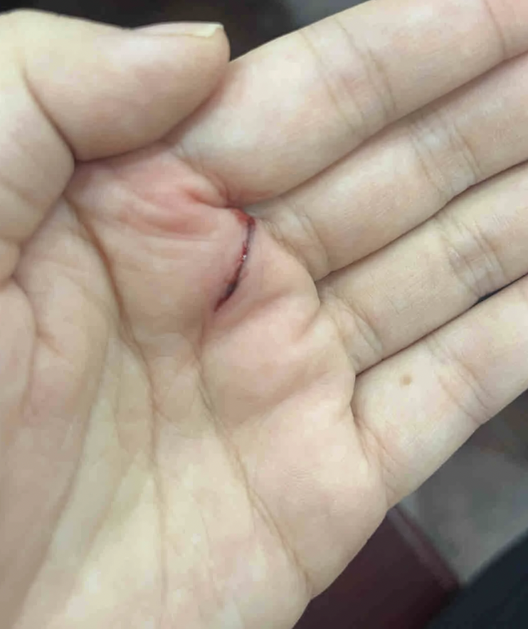 铅笔划伤皮肤后要不要打破伤风疫苗,主要看伤口深浅