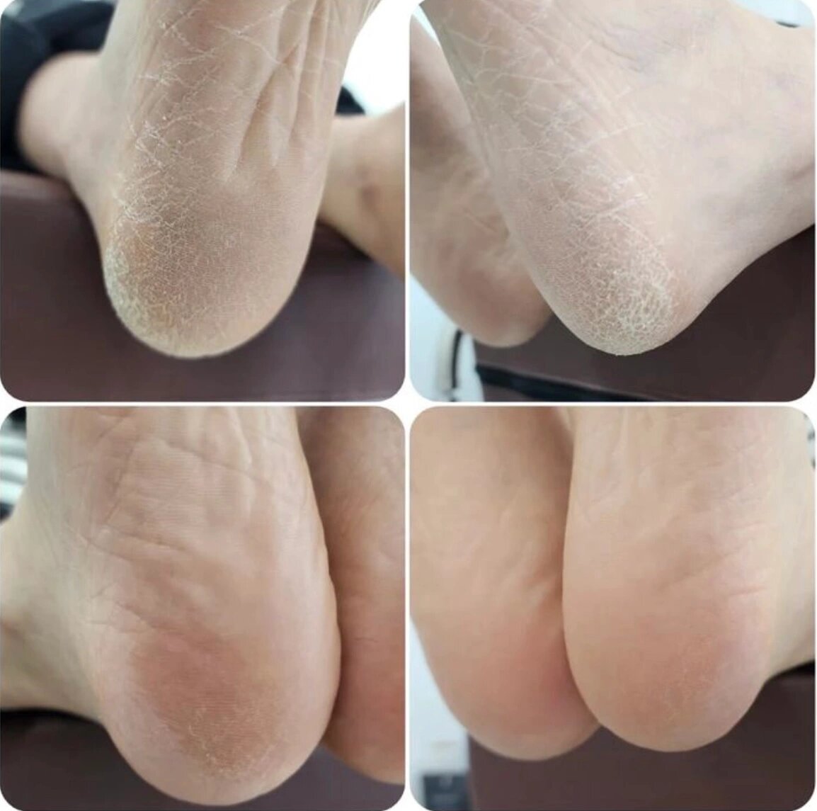 足部角质厚的仙女看过来哦9895原图对比
