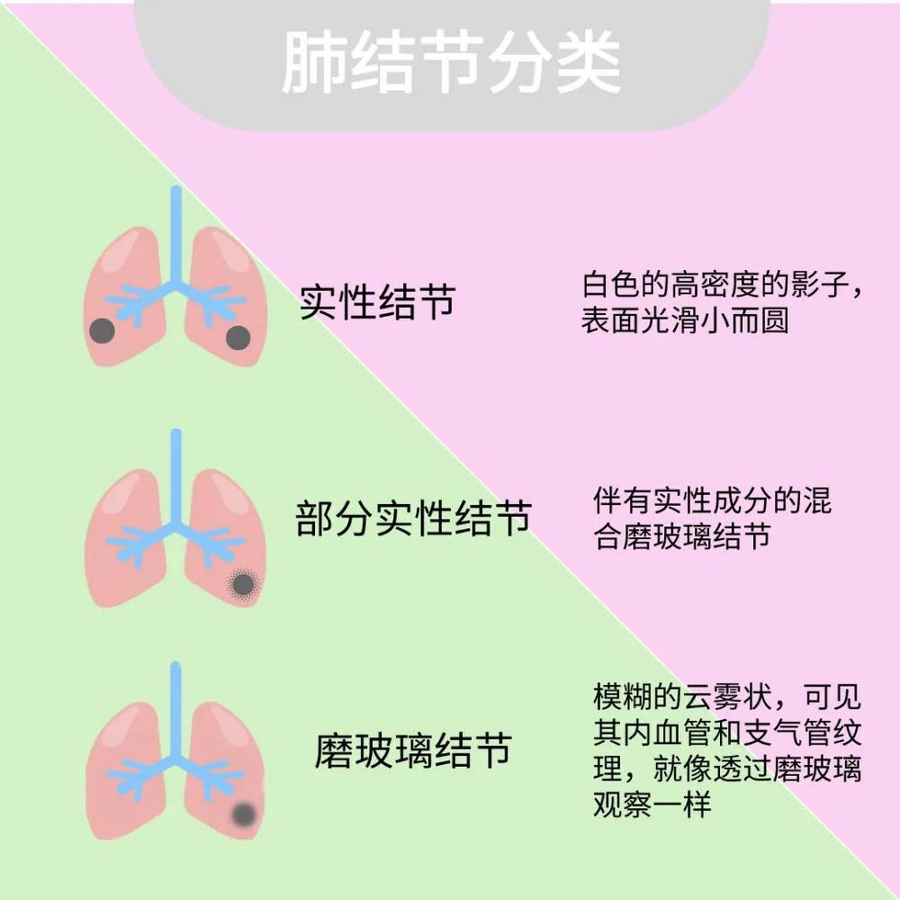 肺结节是指直径小于3cm的肺部影像学表现为圆形或椭圆形的病灶