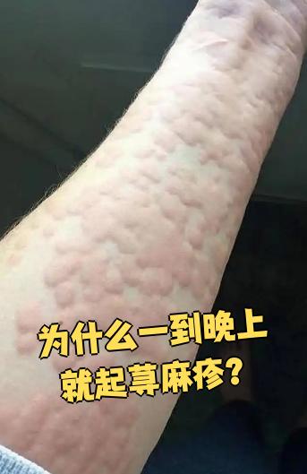 皮肤过敏最怕的克星百科在线