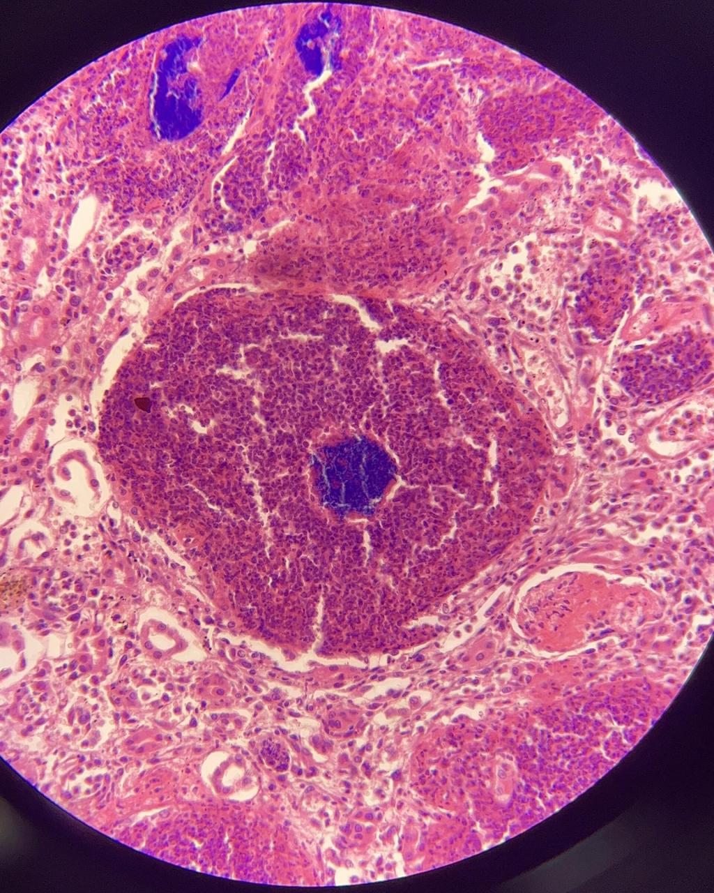 病理绘图|7肾脓肿(读医两年治好了我的…… 密恐