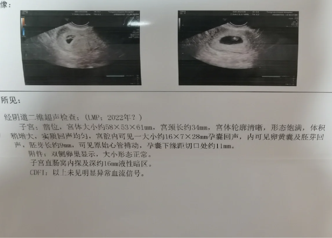 宫外孕吃药打胎需要超度吗的简单介绍