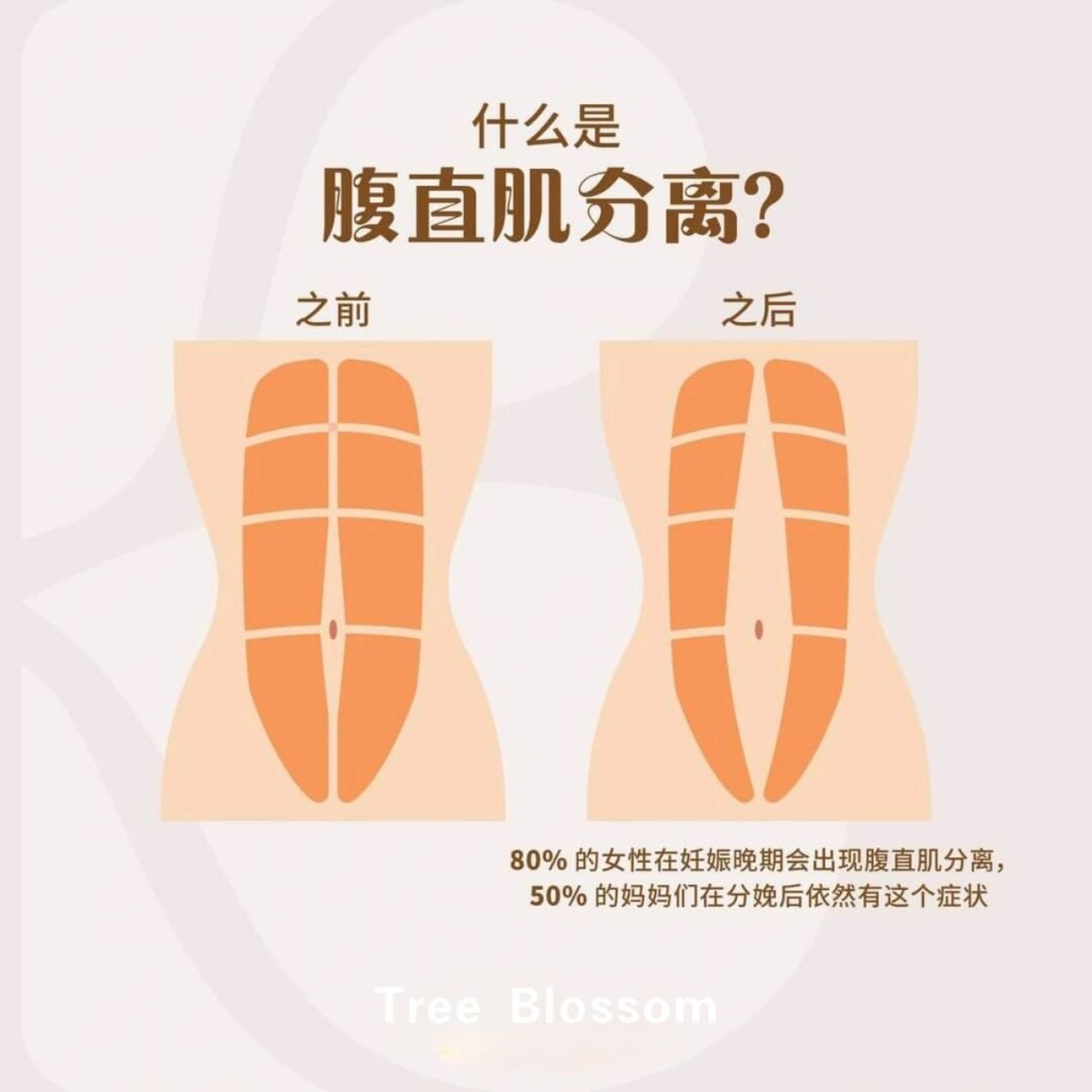 什么是腹直肌分离?