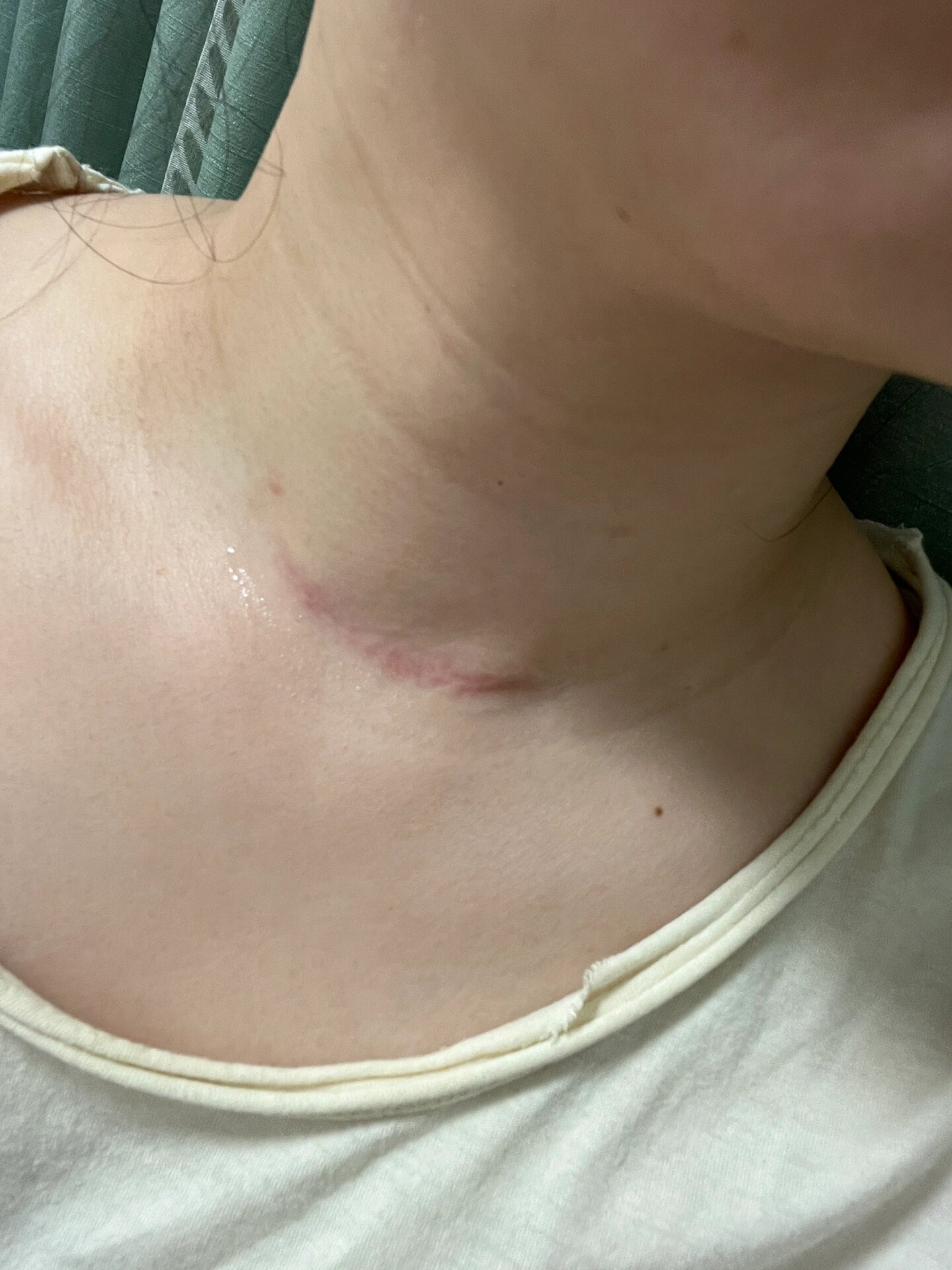 甲状腺术后一年的疤痕