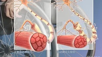 了解"渐冻症"病因 渐冻症学名为肌萎缩性脊髓侧索硬化症(简称als),是