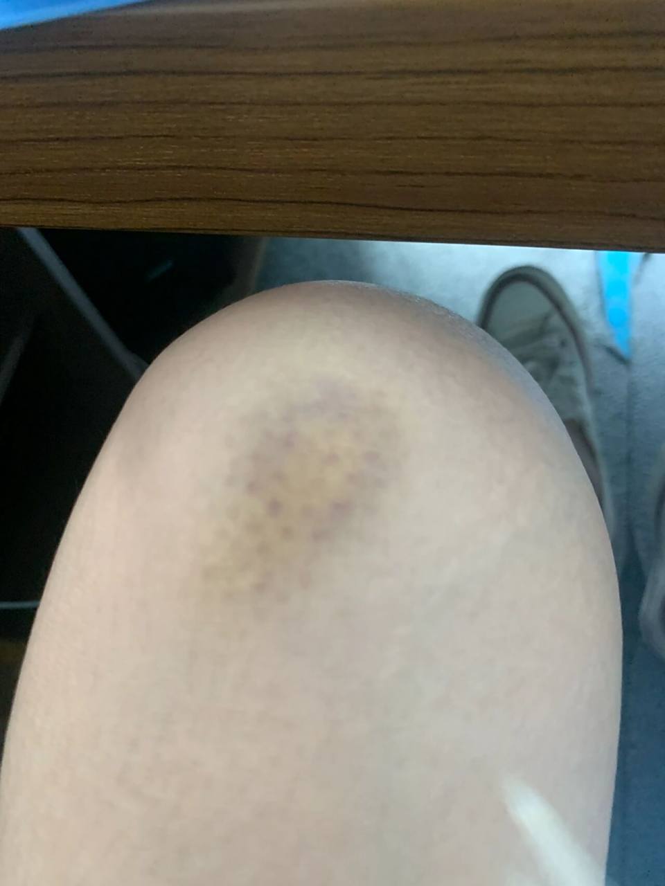 撞到一块淤青,已经一周了,还没有好转