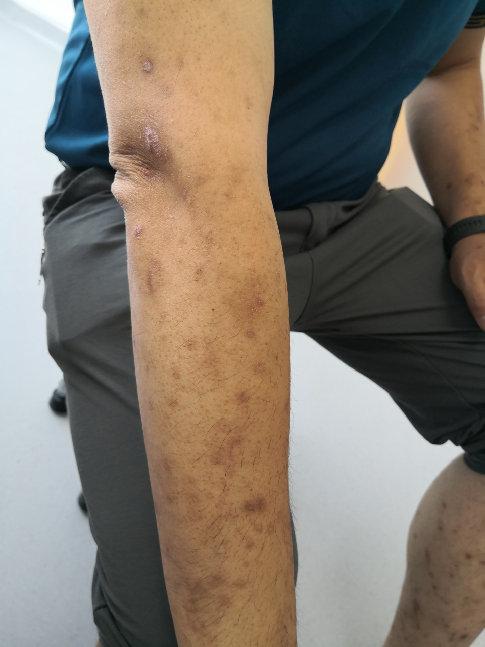 过敏体质患者,全身泛发红斑丘疹血痂抓痕症状.考虑特应性皮炎的诊断.