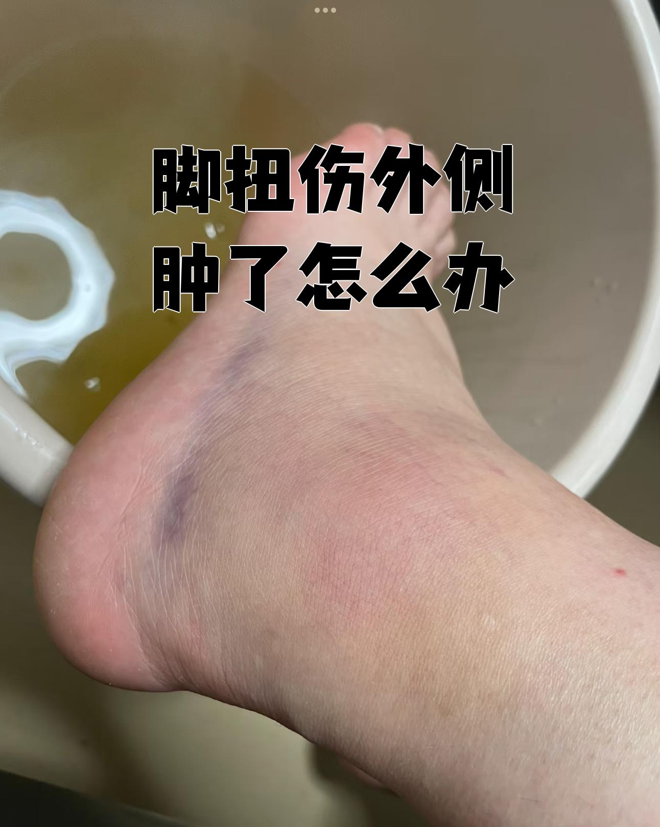 脚扭伤后,脚面外侧肿胀是常见症状,这通常与软