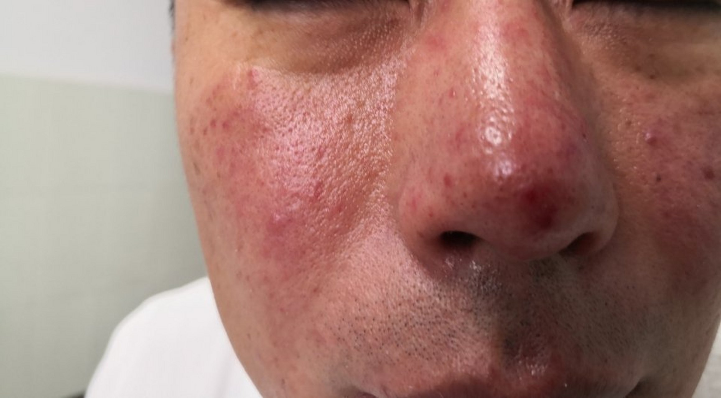 玫瑰痤疮##解决皮肤问题专注皮肤美容