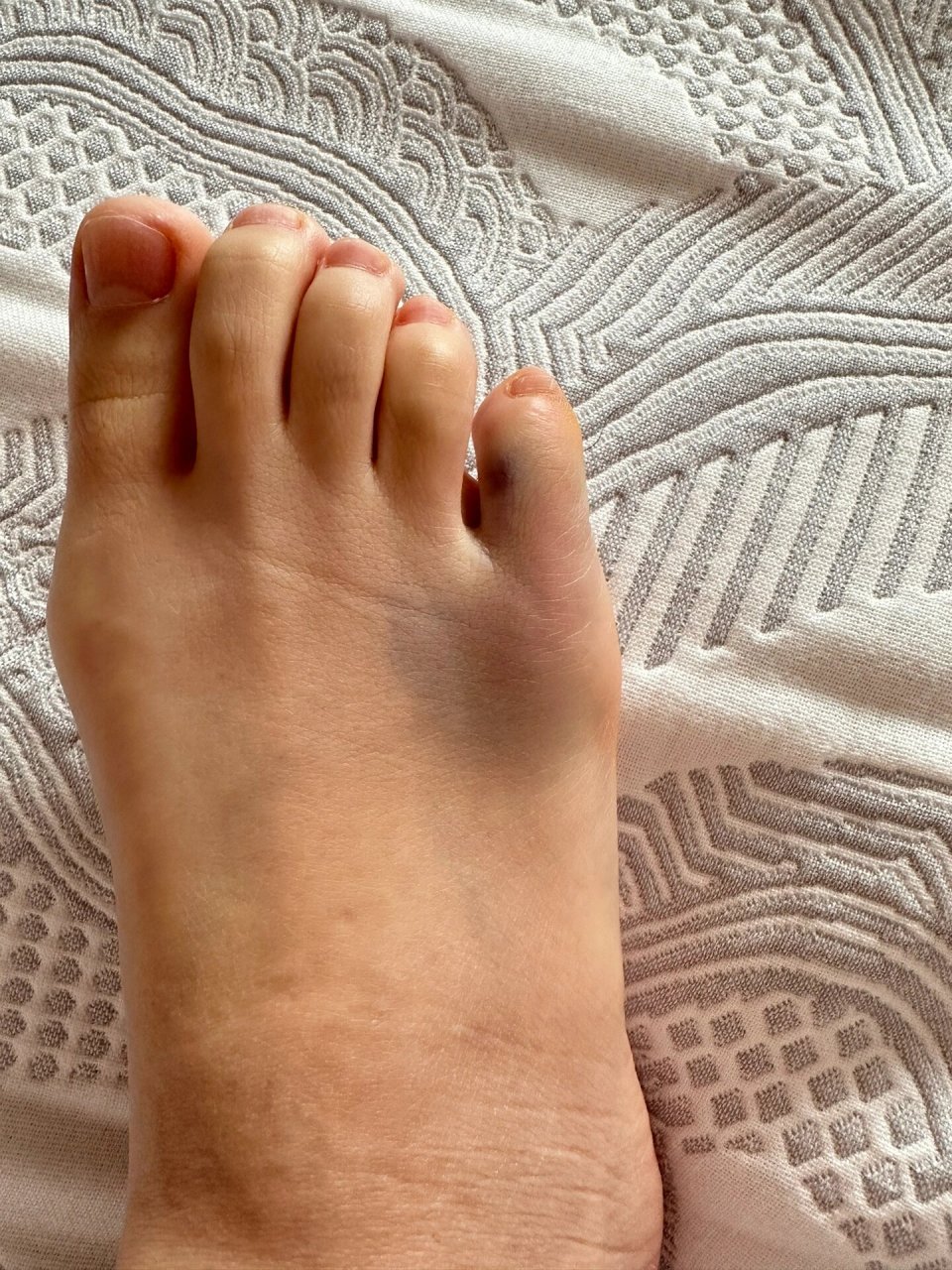 小脚趾头会是骨裂或骨折吗?