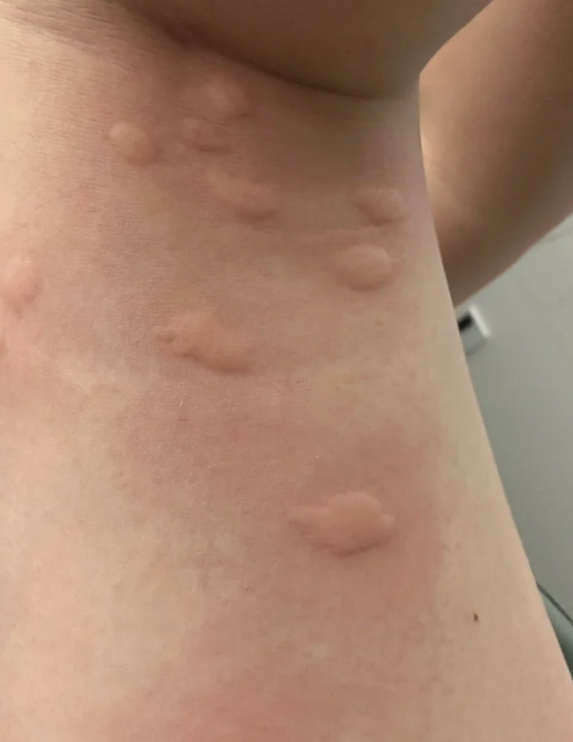 蚊子包为什么会痒痒为什么在线 蚊子包为什么会痒痒为什么在线