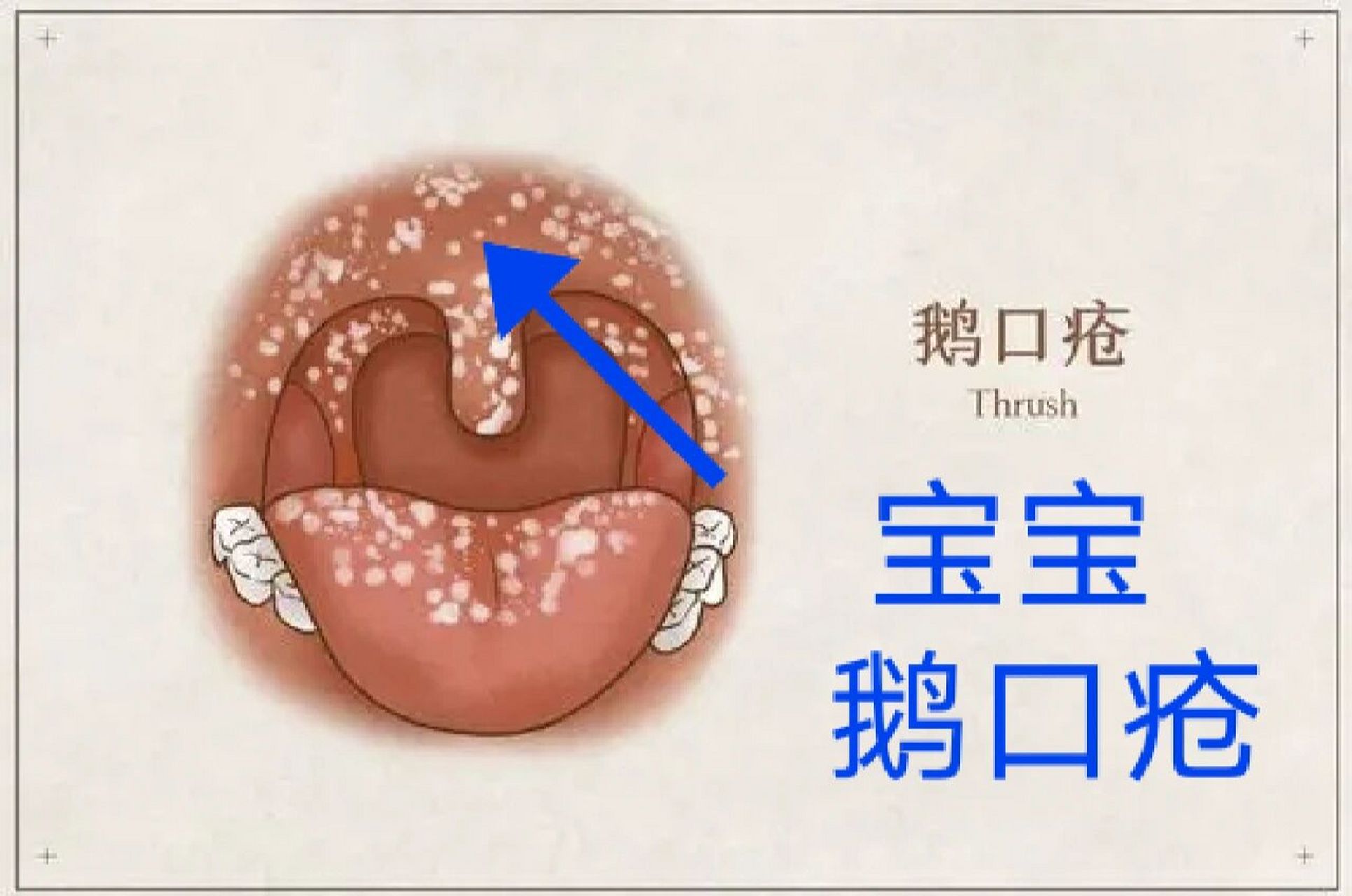 科普:一文读懂宝宝鹅口疮 96症状 鹅口疮为白色念珠菌在口腔粘膜