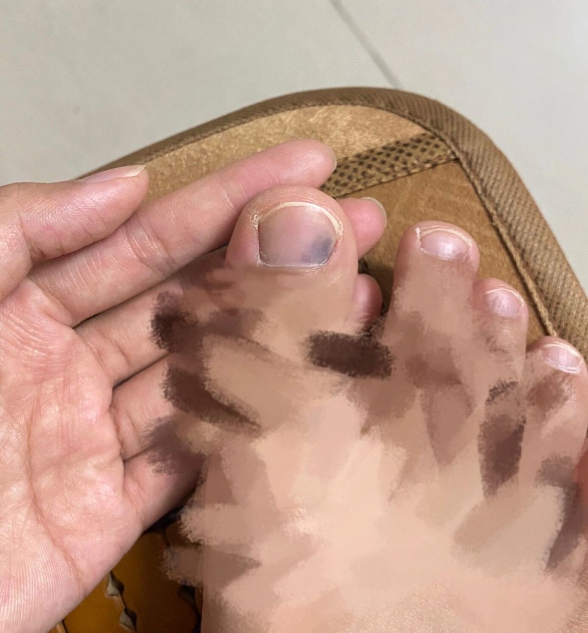 脚指甲里突然黑了一块 前几天17号有去爬山,但是回来一直没注意到