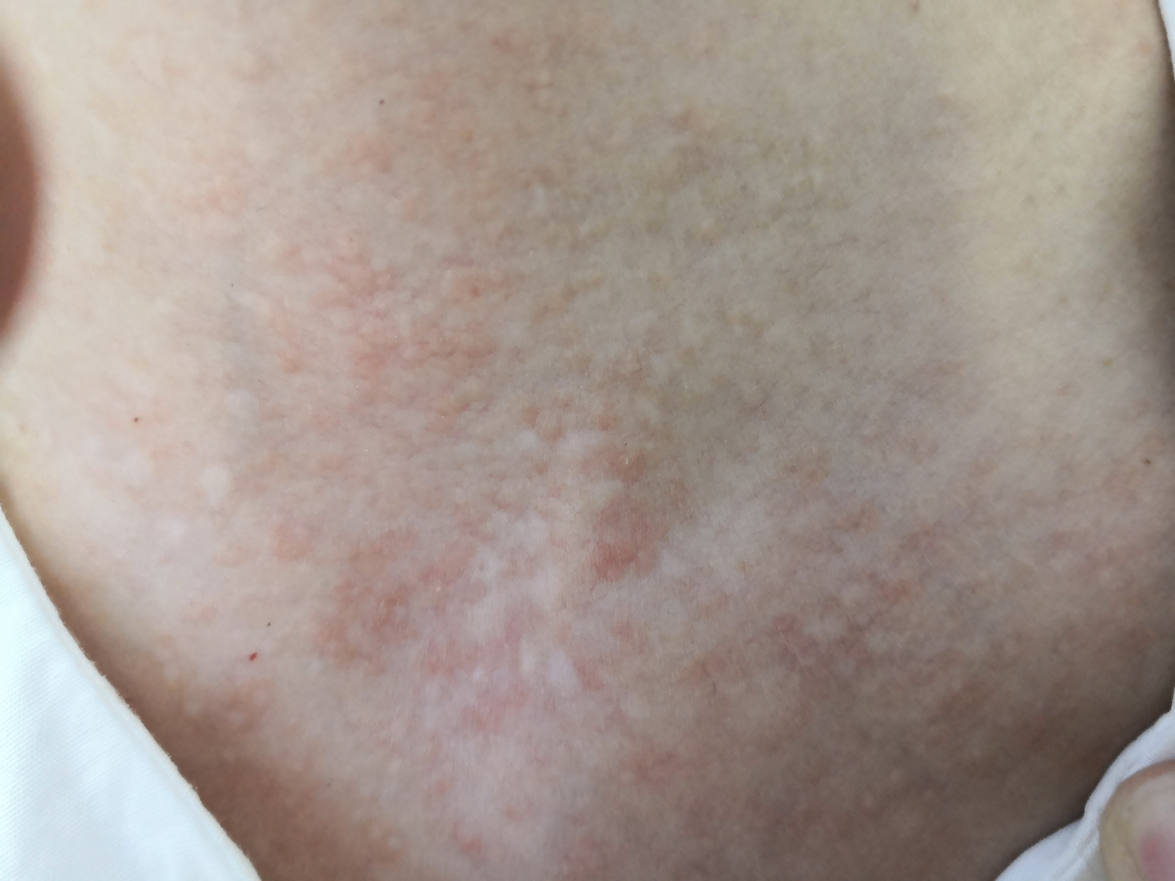 前胸颈周的发疹性汗管瘤.