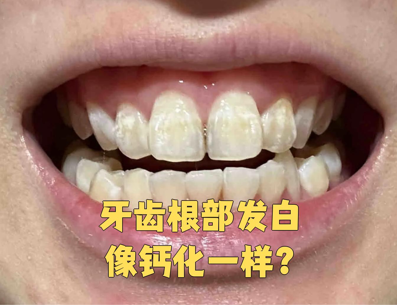 牙齿根部发白像钙化一样?