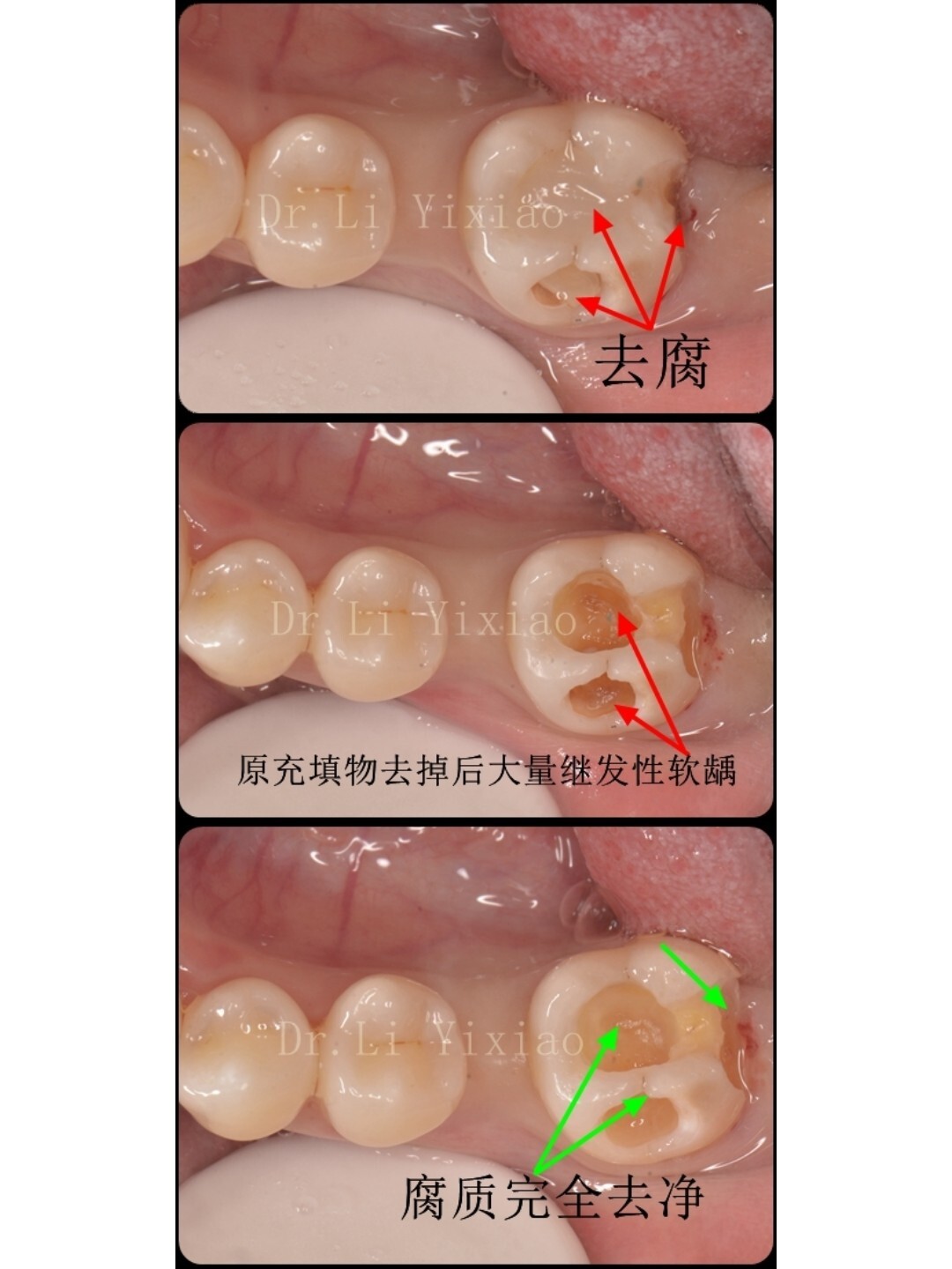 深龋去净腐质的标准图图片