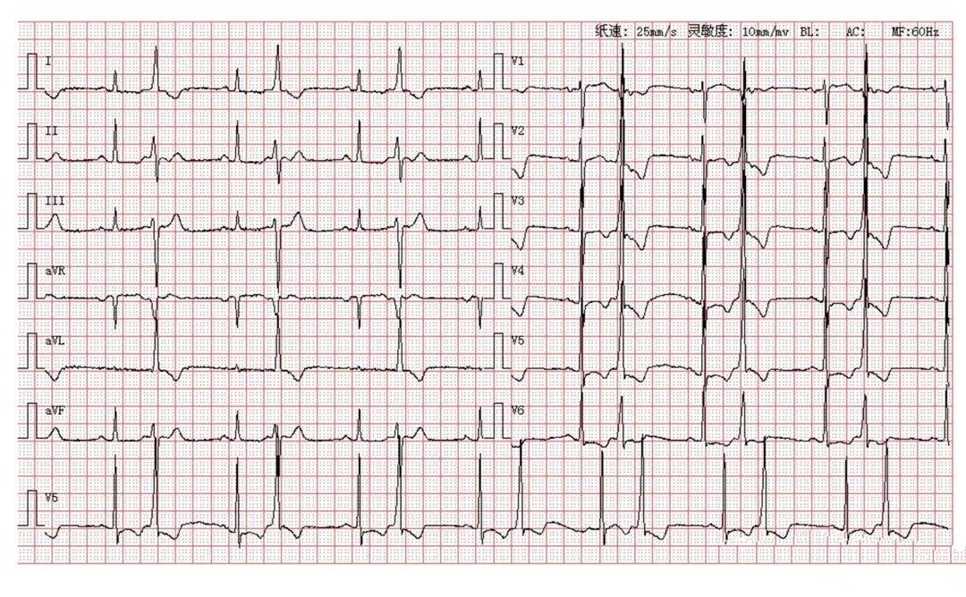 st-t异常 .室性早搏二联律 3.
