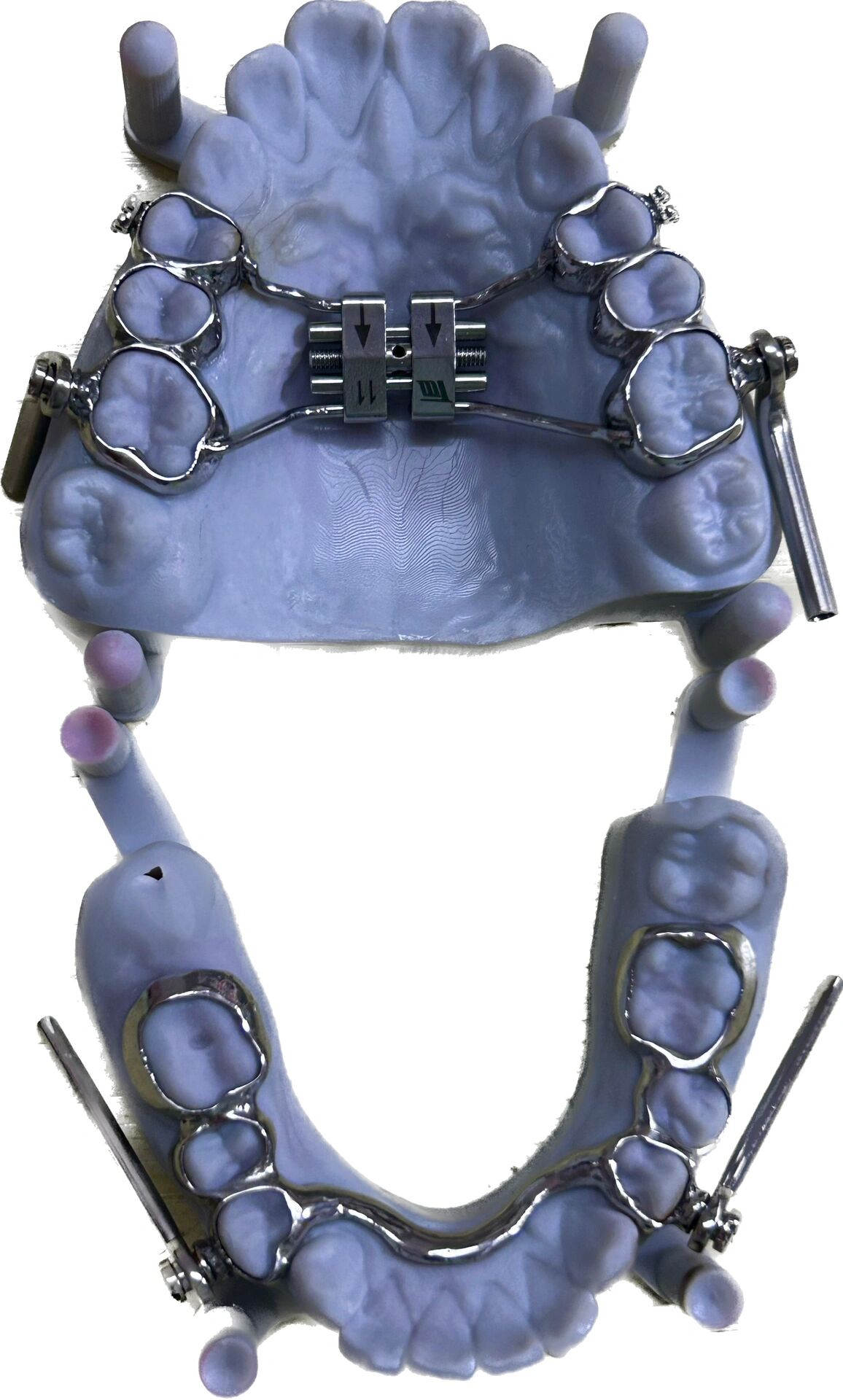 herbst 咬颌前移器(导下颌向前