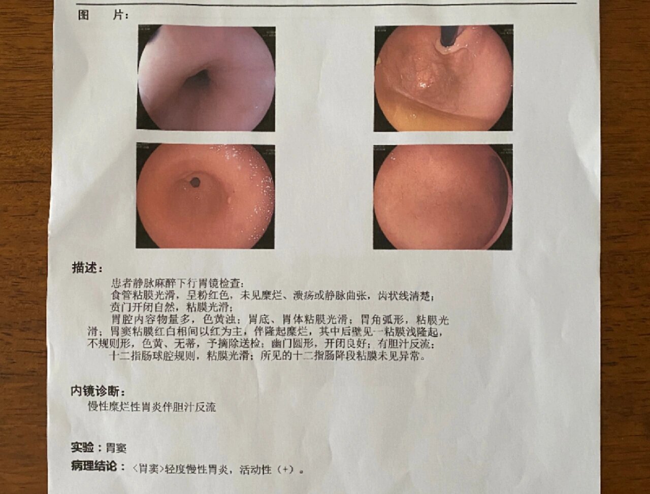 胃窦活检报告图片