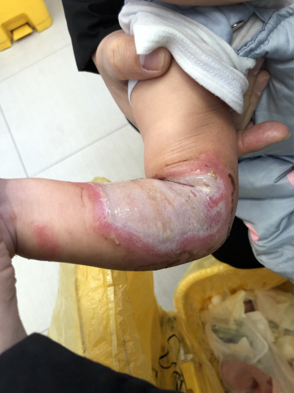 20个月的宝宝三度烫伤 皓皓距烫伤已经一年多了!